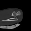SPORK, NICO - 22.03.1976 - 02.08.2022 - CT obere Extremität - 18:02:23